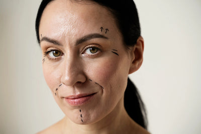 Mulher branca com marcações no rosto se preparando para o procedimento de preenchimento de bigode chines.